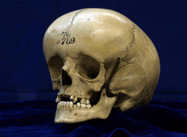 A hydrocephalusban szenvedő személy megnagyobbodott koponyája, amely a kamrai rendszerben a túlzott CSF tünete.