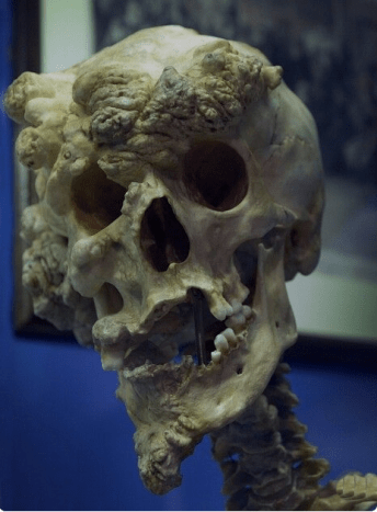 Ez Joseph Merrick koponyája, más néven Az elefántember.