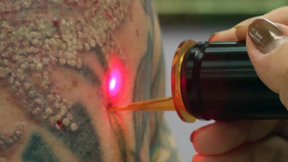laser-tatovering-fjerning