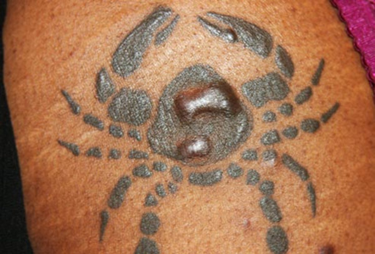 tetoválás-okoz-keloid-of-tetoválás-problémák-diavetítés-amikor-tetoválás-fertőz