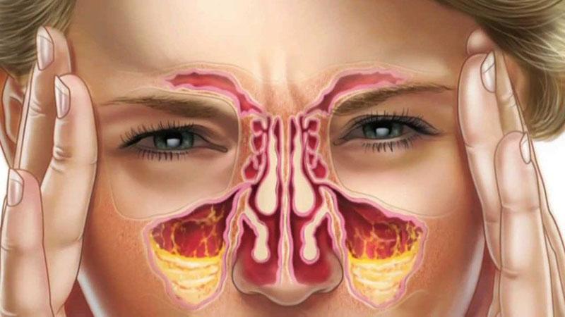 liječenje sinusitisa i sinusitisa