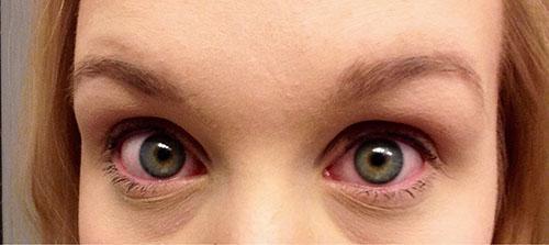 Roodheid van de ogen is een van de symptomen van allergieën