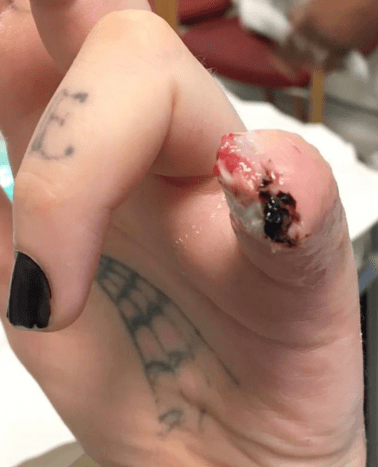Torz Reynolds finger cut off pinky body mods tattoos