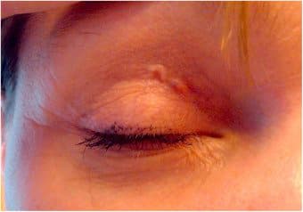 I følge New England Journal of Medicine rapporterte den 32 år gamle kvinnen først at hun merket merkelige støt under venstre øye som senere beveget seg over øyet og deretter ned til overleppen.