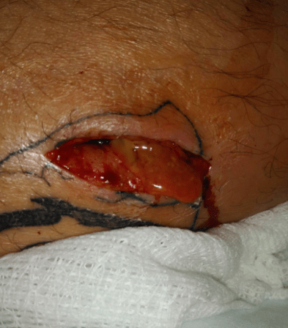 cellulitis a fertőzött tetoválásból