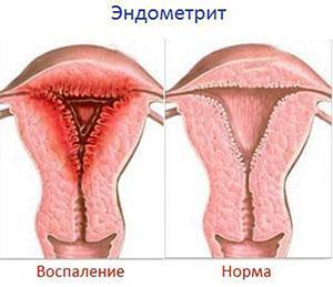 Endometritis diagnostiek