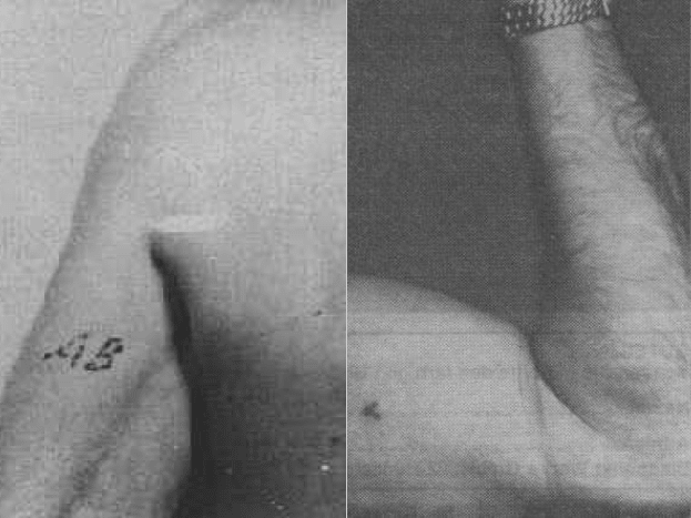 Foto via wikiOffisielt hadde alle medlemmer av Waffen-SS tatoverte blodgruppen på innsiden av venstre overarm. En medisinsk enhet brukte det, vanligvis under grunnopplæringen. Hvis noen savnet tatovering, skulle den påføres under påfølgende medisinsk behandling.