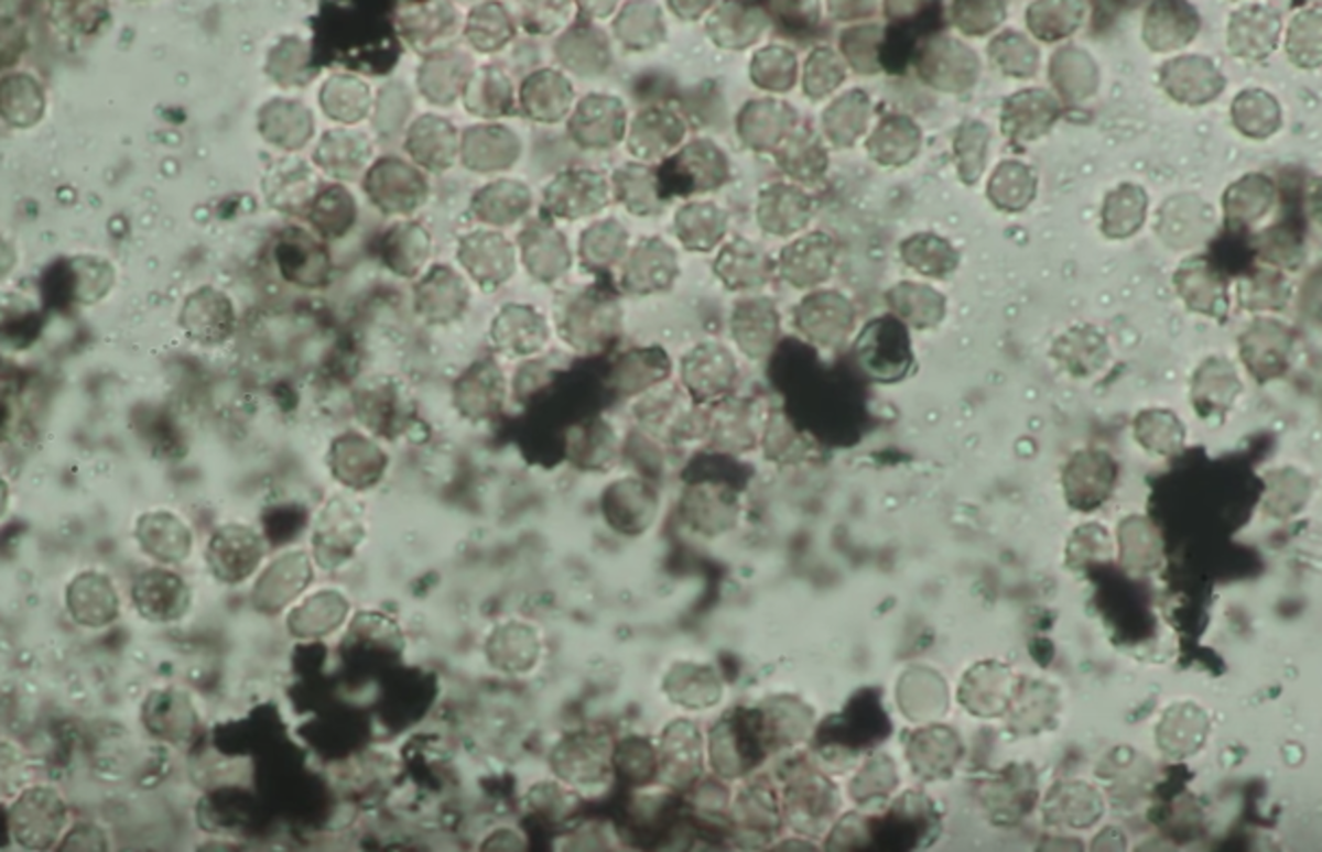 tatoveringsblekk og hvite blodlegemer under mikroskop