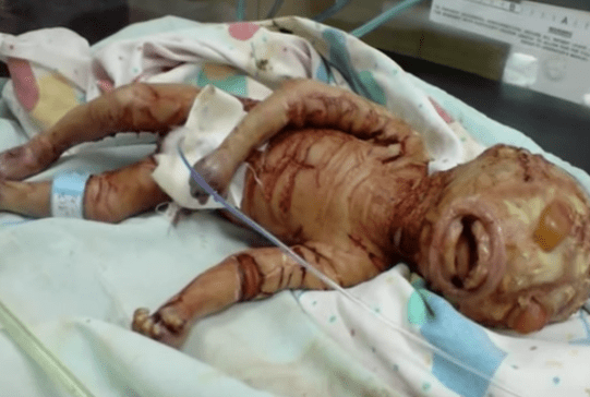 baby født uten hud