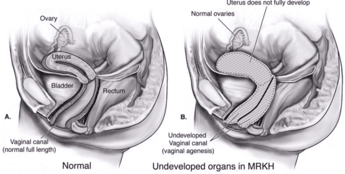 Az MRKH számos változata létezik, amelyekben a reproduktív szervek vagy fejletlenek, vagy teljesen hiányoznak. Azonban a külső nemi szervek és a mellfejlődés jellemzően normális az MRKH -ban szenvedő nőknél.