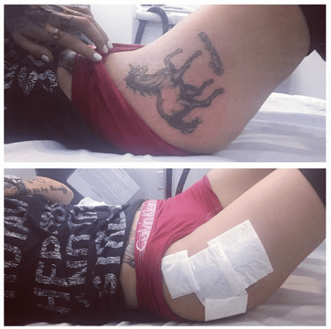 Ruby Rose deler et bilde etter den første av 10 økter for fjerning av tatoveringer.