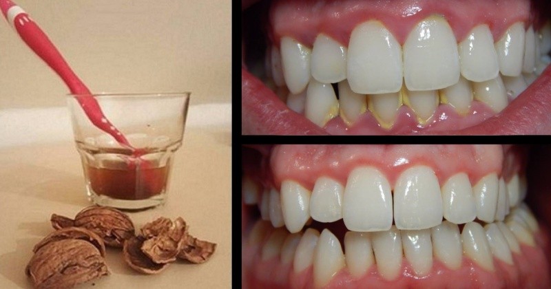 hoe gebruik je walnoten tegen tandsteen?