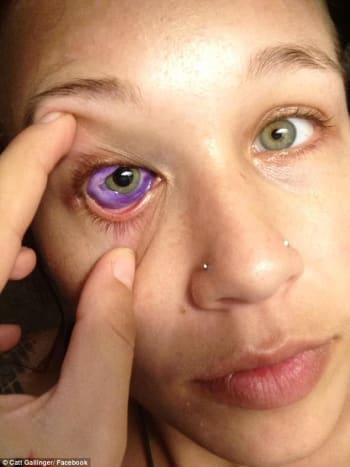 צילום באמצעות קאט גלינגר לאחר שבחנה את עינה, הסיקו הרופאים כי העין של גלינגר נפגעה לצמיתות ויש לה פוטנציאל להסיר אותה בעתיד.