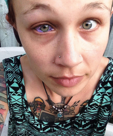 Foto via Catt Gallinger 24-åringen begynte å legge merke til at det nye blekket hennes ikke var helt riktig da blekket begynte å dryppe fra øyet og klumpe seg rundt hornhinnen.