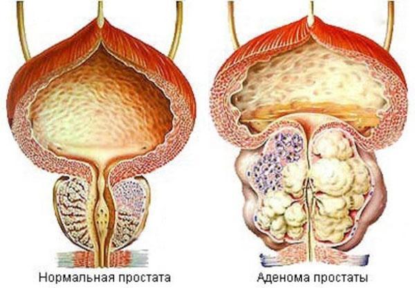 gljiva veselka za liječenje prostate