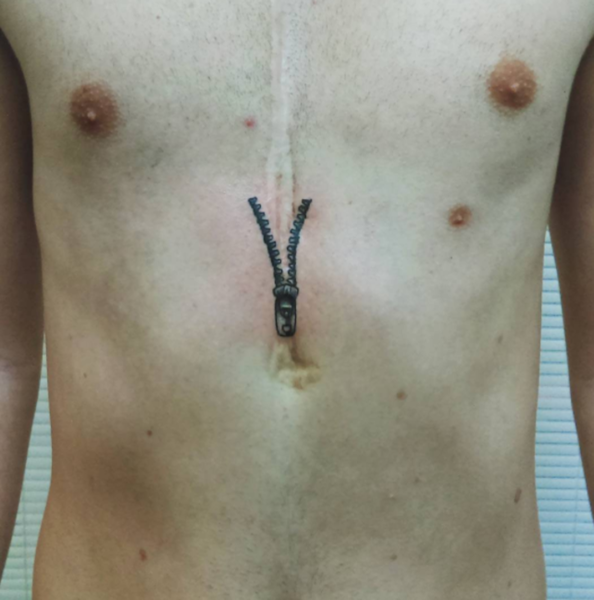 nyitott szívműtét heg tetoválás